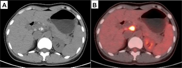 https://cdn.ncbi.nlm.nih.gov/pmc/blobs/cbaf/7719304/f3c68283bfb1/IJGM-13-1335-g0003.jpg