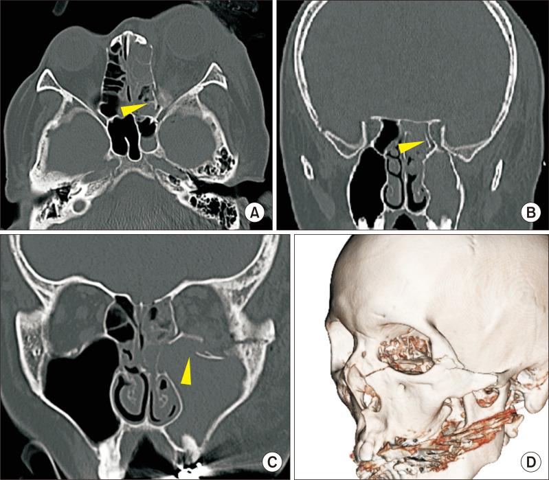 https://cdn.ncbi.nlm.nih.gov/pmc/blobs/cbb4/11535127/089902f11c41/jkaoms-50-5-273-f2.jpg