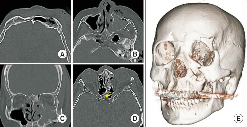 https://cdn.ncbi.nlm.nih.gov/pmc/blobs/cbb4/11535127/2e34b44adcf3/jkaoms-50-5-273-f6.jpg