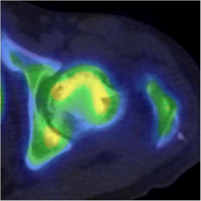 https://cdn.ncbi.nlm.nih.gov/pmc/blobs/cbdb/6132897/200691349a1d/jbjsoa-2-e0013-g010.jpg