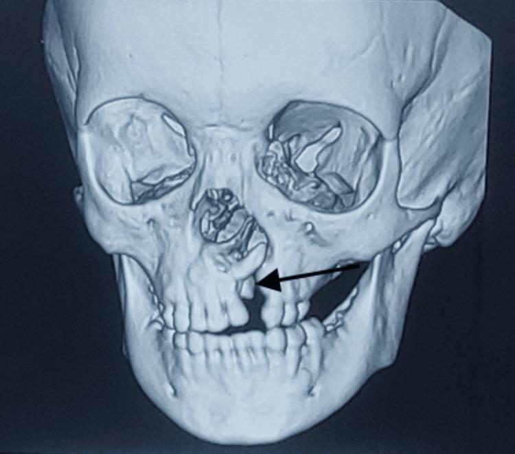 https://cdn.ncbi.nlm.nih.gov/pmc/blobs/cbf6/10981788/b278ec2143ed/cureus-0016-00000055303-i02.jpg