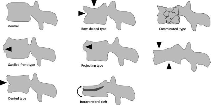 https://cdn.ncbi.nlm.nih.gov/pmc/blobs/cc14/8907647/a3fc30dd36b7/10.1177_2192568220982279-fig2.jpg