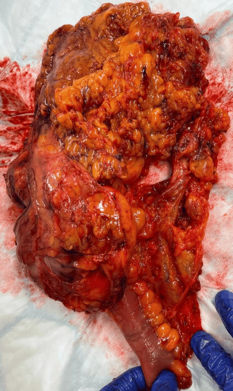 https://cdn.ncbi.nlm.nih.gov/pmc/blobs/cc39/12067811/d0c9825e77c0/cureus-0017-00000082133-i03.jpg