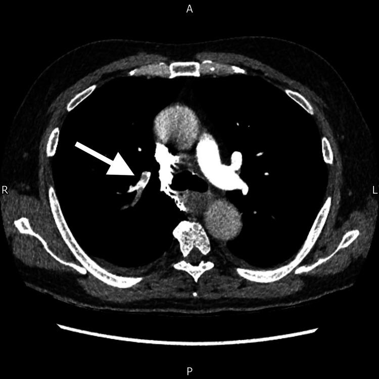 https://cdn.ncbi.nlm.nih.gov/pmc/blobs/cc39/12067811/f06ecb922d1c/cureus-0017-00000082133-i04.jpg