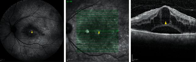 https://cdn.ncbi.nlm.nih.gov/pmc/blobs/cc49/9170455/caee34913ed7/JOPH2022-6831396.002.jpg