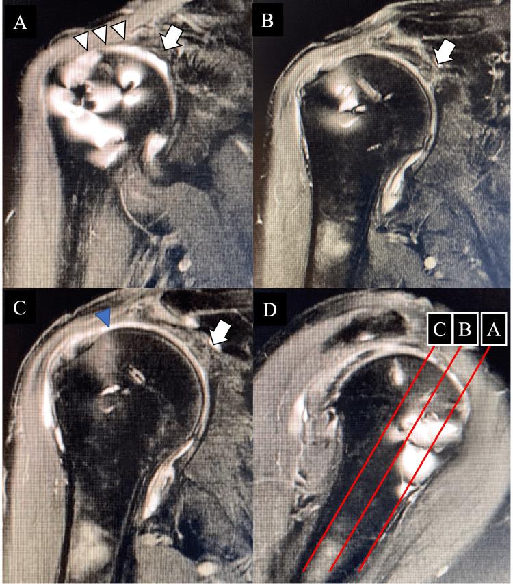 https://cdn.ncbi.nlm.nih.gov/pmc/blobs/cc5d/11093772/c9e3ab2ba505/cureus-0016-00000058260-i03.jpg