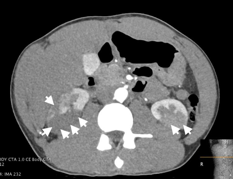 https://cdn.ncbi.nlm.nih.gov/pmc/blobs/cc88/11128336/b4854e034b25/cureus-0016-00000059095-i01.jpg
