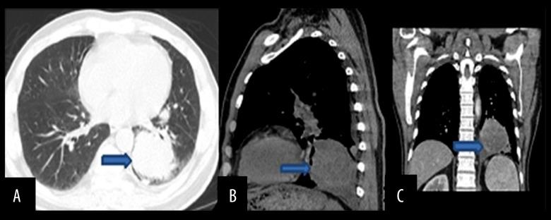 https://cdn.ncbi.nlm.nih.gov/pmc/blobs/cca4/5510997/6dc240a955b9/amjcaserep-18-760-g002.jpg