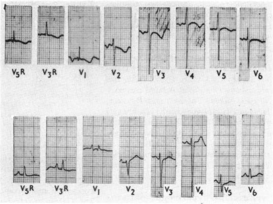 https://cdn.ncbi.nlm.nih.gov/pmc/blobs/ccdd/458516/114a6ceddccb/brheartj00293-0011-a.jpg