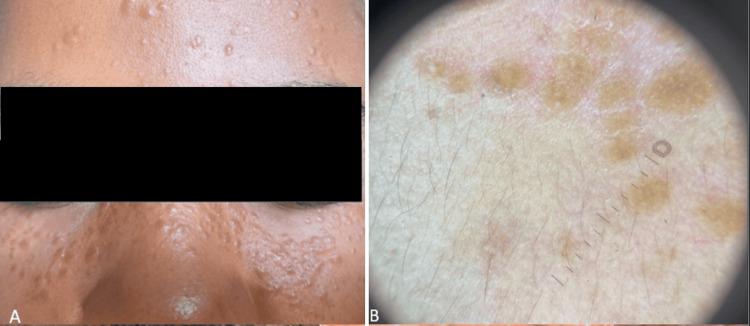 https://cdn.ncbi.nlm.nih.gov/pmc/blobs/cd08/12279288/bbd406708731/cureus-0017-00000086501-i04.jpg