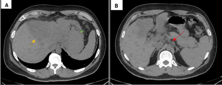 https://cdn.ncbi.nlm.nih.gov/pmc/blobs/cd1d/10313214/fc6956aa647c/cureus-0015-00000039787-i01.jpg