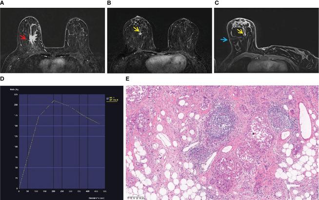 https://cdn.ncbi.nlm.nih.gov/pmc/blobs/cd40/11157007/5539137c6f04/fonc-14-1325362-g001.jpg