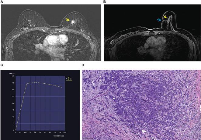 https://cdn.ncbi.nlm.nih.gov/pmc/blobs/cd40/11157007/a5ff135d3f56/fonc-14-1325362-g003.jpg
