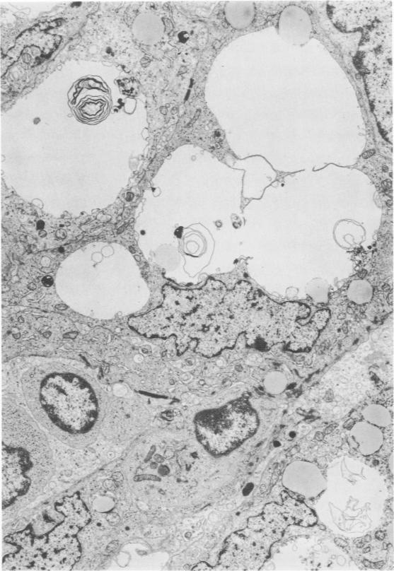 https://cdn.ncbi.nlm.nih.gov/pmc/blobs/cd85/2032290/1368980c2d51/amjpathol00455-0088-a.jpg