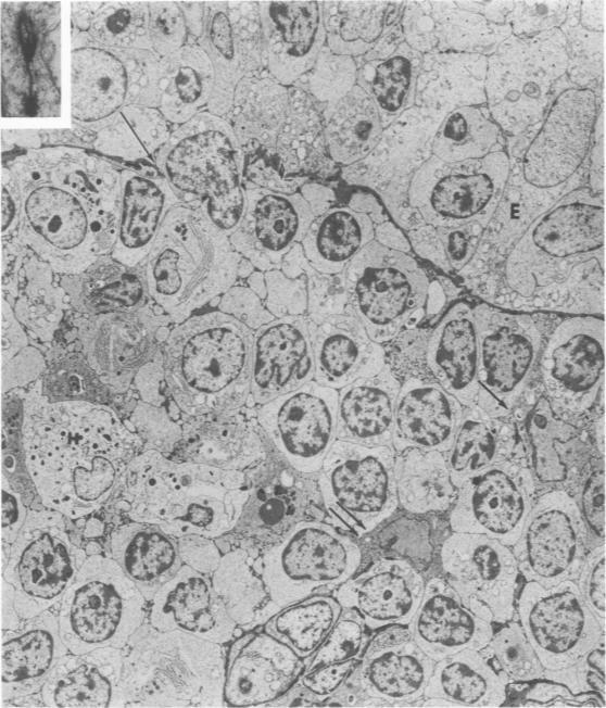 https://cdn.ncbi.nlm.nih.gov/pmc/blobs/cd85/2032290/f9d0975737e3/amjpathol00455-0094-a.jpg