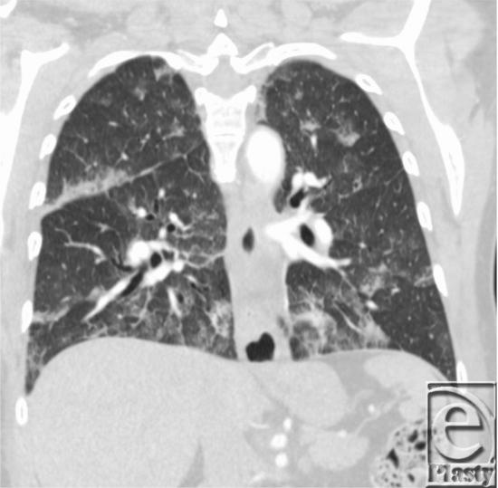 https://cdn.ncbi.nlm.nih.gov/pmc/blobs/cd96/4104114/f62541753a0f/eplasty14ic19_fig2.jpg
