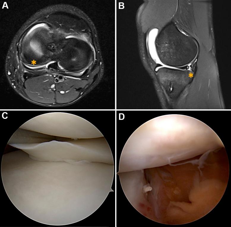 https://cdn.ncbi.nlm.nih.gov/pmc/blobs/cdd3/9989402/7845f7f7499b/10.1177_23259671231153629-fig2.jpg