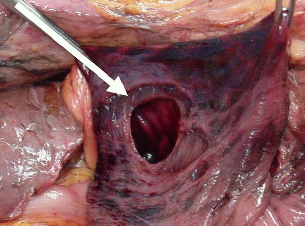 https://cdn.ncbi.nlm.nih.gov/pmc/blobs/ce3d/2726547/1475d5cbe3d3/1752-1947-0003-0000006507-3.jpg