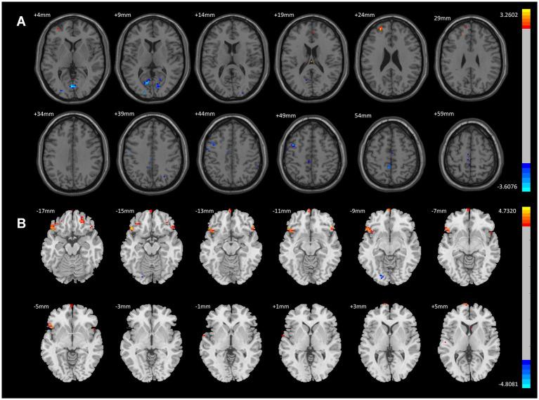 https://cdn.ncbi.nlm.nih.gov/pmc/blobs/ce55/12206823/9b7093089696/fnins-19-1610657-g002.jpg