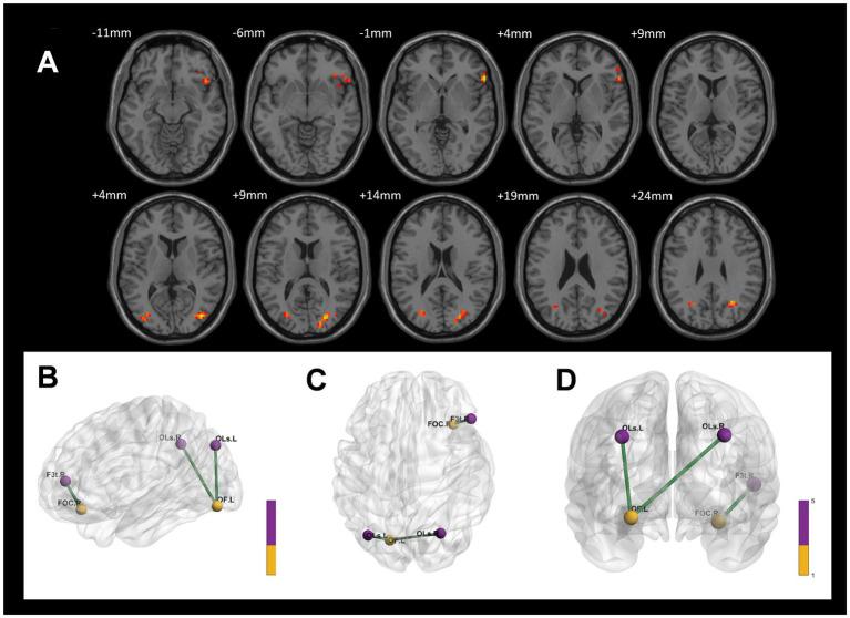 https://cdn.ncbi.nlm.nih.gov/pmc/blobs/ce55/12206823/af5f011f851a/fnins-19-1610657-g006.jpg