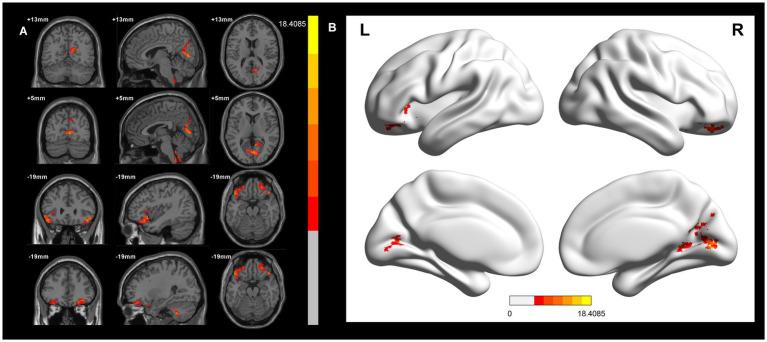 https://cdn.ncbi.nlm.nih.gov/pmc/blobs/ce55/12206823/f3dc28749eba/fnins-19-1610657-g001.jpg