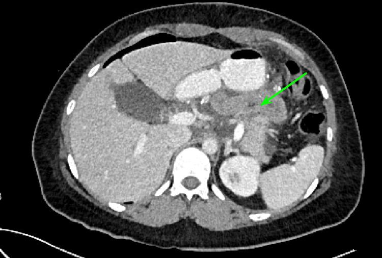 https://cdn.ncbi.nlm.nih.gov/pmc/blobs/ce84/11164693/84e5b4e4aa9e/cureus-0016-00000060116-i07.jpg
