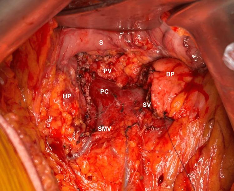 https://cdn.ncbi.nlm.nih.gov/pmc/blobs/ce84/11164693/9ede569241ac/cureus-0016-00000060116-i02.jpg