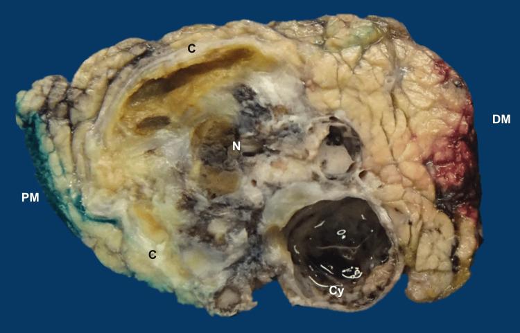 https://cdn.ncbi.nlm.nih.gov/pmc/blobs/ce84/11164693/d7d90228b3d5/cureus-0016-00000060116-i04.jpg