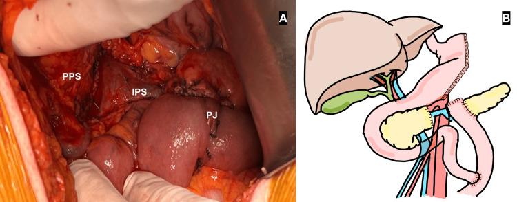 https://cdn.ncbi.nlm.nih.gov/pmc/blobs/ce84/11164693/ef8ec5890af4/cureus-0016-00000060116-i03.jpg