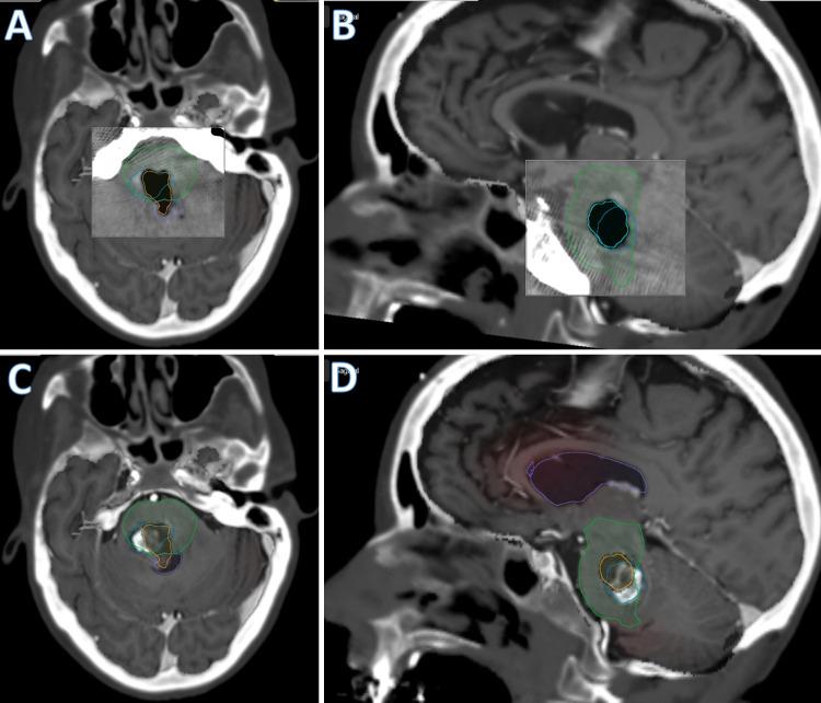 https://cdn.ncbi.nlm.nih.gov/pmc/blobs/cea9/9204912/7c0cd4b5776b/CASE21683f2.jpg