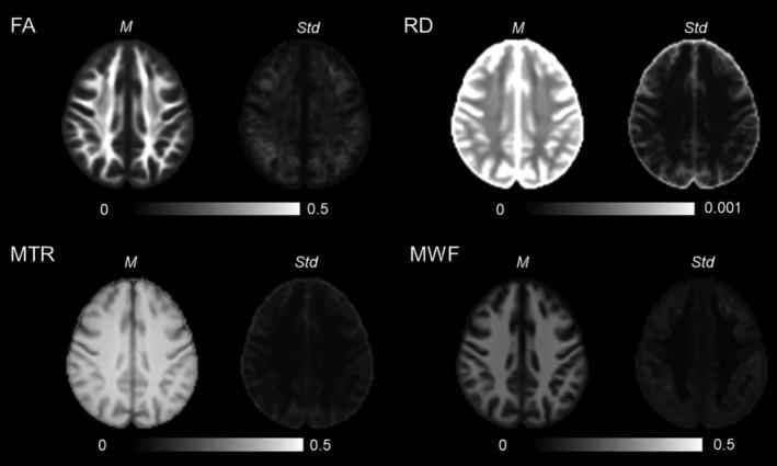 https://cdn.ncbi.nlm.nih.gov/pmc/blobs/ceb1/6865710/203a0c70b231/HBM-40-2917-g003.jpg