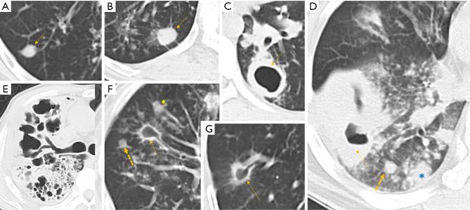 https://cdn.ncbi.nlm.nih.gov/pmc/blobs/ceeb/9344412/35998b03a834/jtd-14-07-2522-f1.jpg