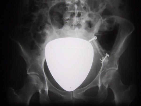 https://cdn.ncbi.nlm.nih.gov/pmc/blobs/cef7/538289/928a9f8d7920/1477-7819-2-38-6.jpg