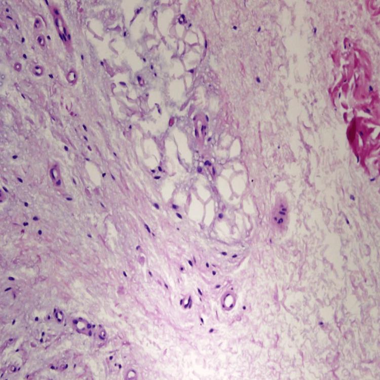 https://cdn.ncbi.nlm.nih.gov/pmc/blobs/cf22/10990651/9a61ffa86370/cureus-0016-00000055509-i04.jpg