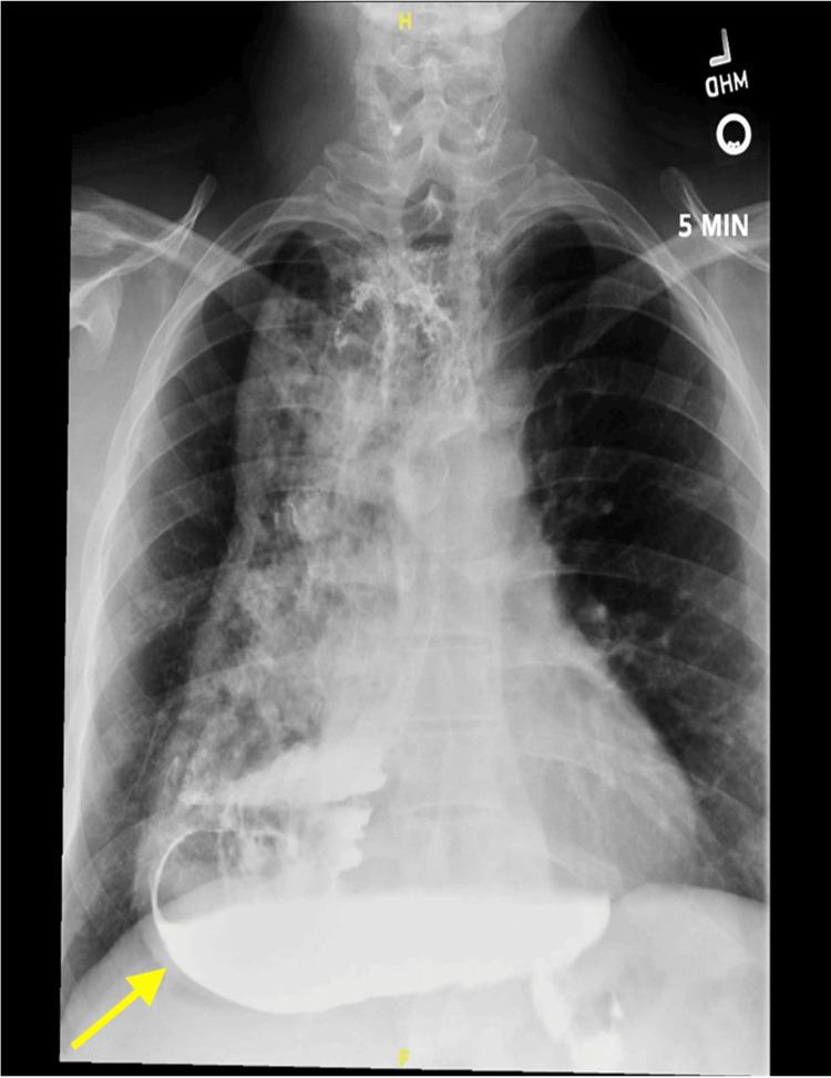 https://cdn.ncbi.nlm.nih.gov/pmc/blobs/cf6c/12398420/9dcecb94a05a/cureus-0017-00000089164-i01.jpg