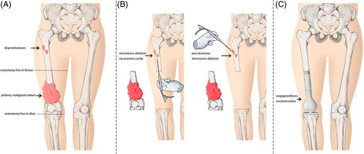 https://cdn.ncbi.nlm.nih.gov/pmc/blobs/cf74/7454210/4725ea3dc2f6/OS-12-1036-g001.jpg
