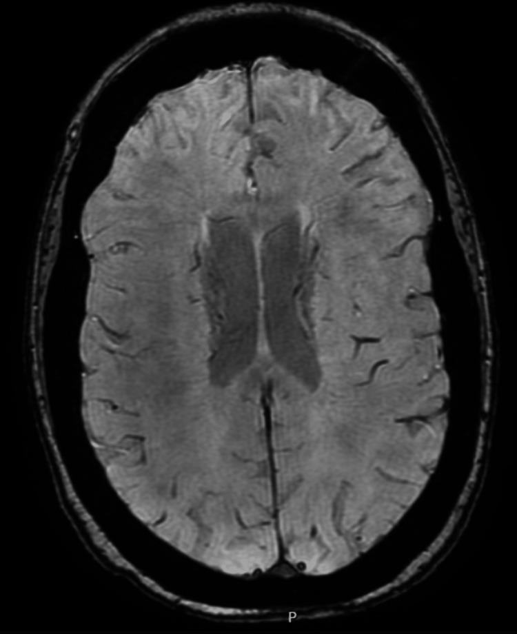 https://cdn.ncbi.nlm.nih.gov/pmc/blobs/cfd6/12166952/492b408be4f2/cureus-0017-00000084167-i02.jpg