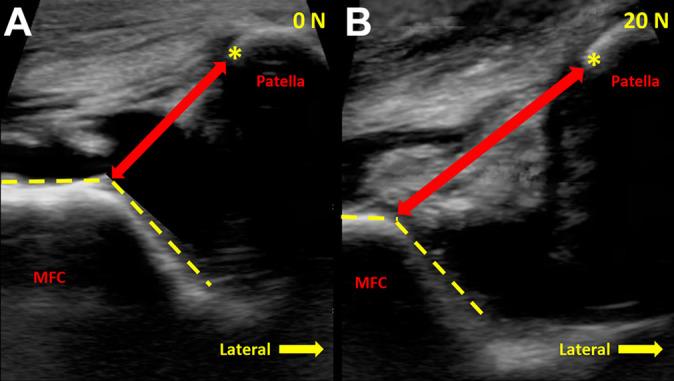 https://cdn.ncbi.nlm.nih.gov/pmc/blobs/cfea/9134436/da07b83040f9/10.1177_23259671221098748-fig2.jpg