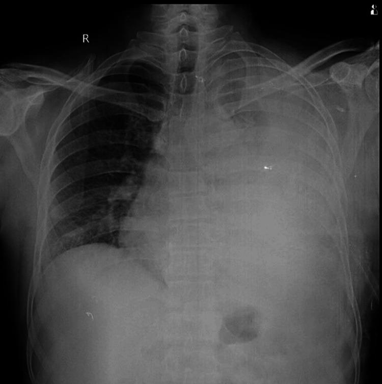 https://cdn.ncbi.nlm.nih.gov/pmc/blobs/d002/11849755/1789f337b0fb/cureus-0017-00000077971-i02.jpg