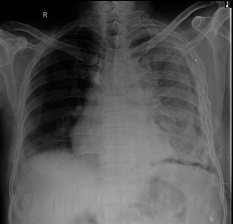 https://cdn.ncbi.nlm.nih.gov/pmc/blobs/d002/11849755/86085ef7e32e/cureus-0017-00000077971-i06.jpg