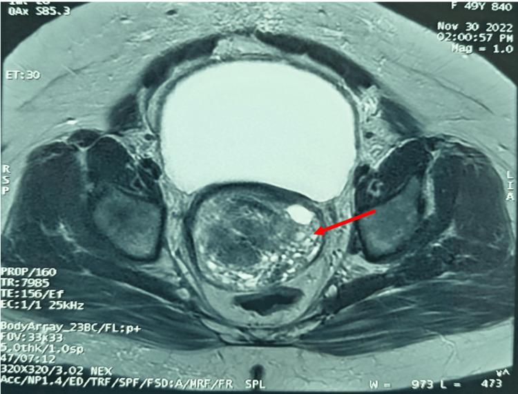 https://cdn.ncbi.nlm.nih.gov/pmc/blobs/d0b8/12393134/78abe0a38919/cureus-0017-00000088983-i01.jpg