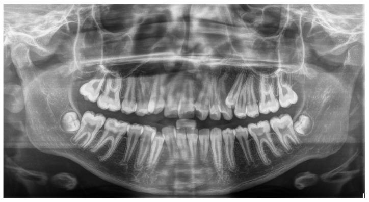 https://cdn.ncbi.nlm.nih.gov/pmc/blobs/d0c9/12293686/58052615170e/dentistry-13-00317-g002.jpg