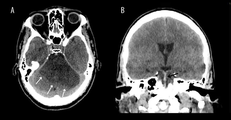 https://cdn.ncbi.nlm.nih.gov/pmc/blobs/d0fc/11138358/58ac1716e8bd/amjcaserep-25-e943506-g001.jpg