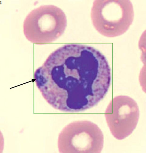 https://cdn.ncbi.nlm.nih.gov/pmc/blobs/d140/11315614/0ebd0e1d3098/amjcaserep-25-e943966-g001.jpg