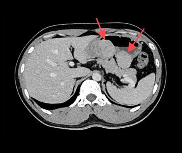 https://cdn.ncbi.nlm.nih.gov/pmc/blobs/d14b/12101094/632cbb708d09/amjcaserep-26-e947545-g001.jpg