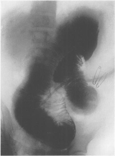 https://cdn.ncbi.nlm.nih.gov/pmc/blobs/d18d/1617628/0a96b9c4c330/annsurg01468-0085-a.jpg