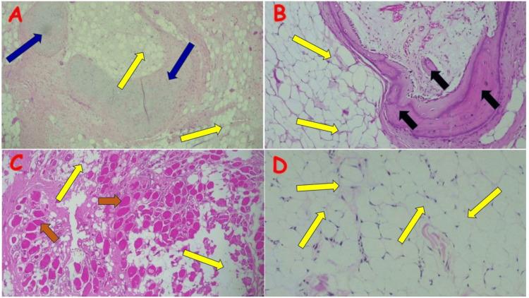https://cdn.ncbi.nlm.nih.gov/pmc/blobs/d1ce/11031710/5825789d8c60/cureus-0016-00000056618-i06.jpg