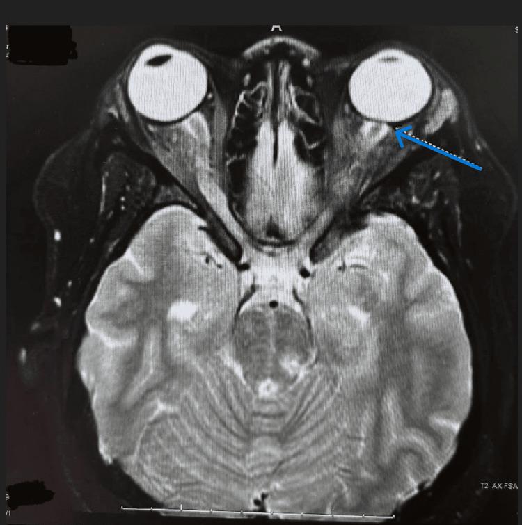 https://cdn.ncbi.nlm.nih.gov/pmc/blobs/d250/12350088/3624b6771d48/cureus-0017-00000087940-i02.jpg