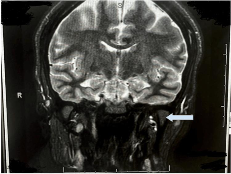 https://cdn.ncbi.nlm.nih.gov/pmc/blobs/d250/12350088/a8ac0c5929b6/cureus-0017-00000087940-i01.jpg