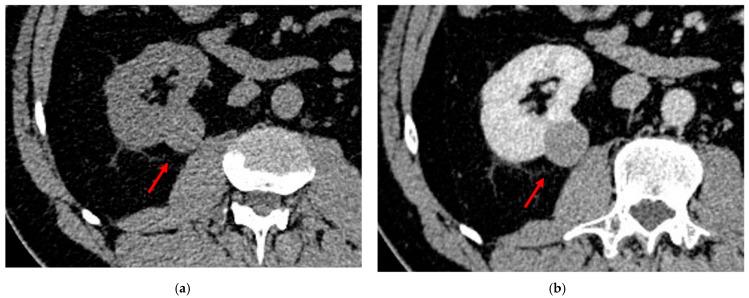 https://cdn.ncbi.nlm.nih.gov/pmc/blobs/d297/9914376/d5962dd2437d/diagnostics-13-00334-g005.jpg